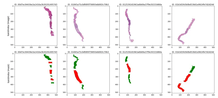 GSoC’22 @ TensorFlow: Segmentation of Prostate Gland Tissue for Cancer Detection